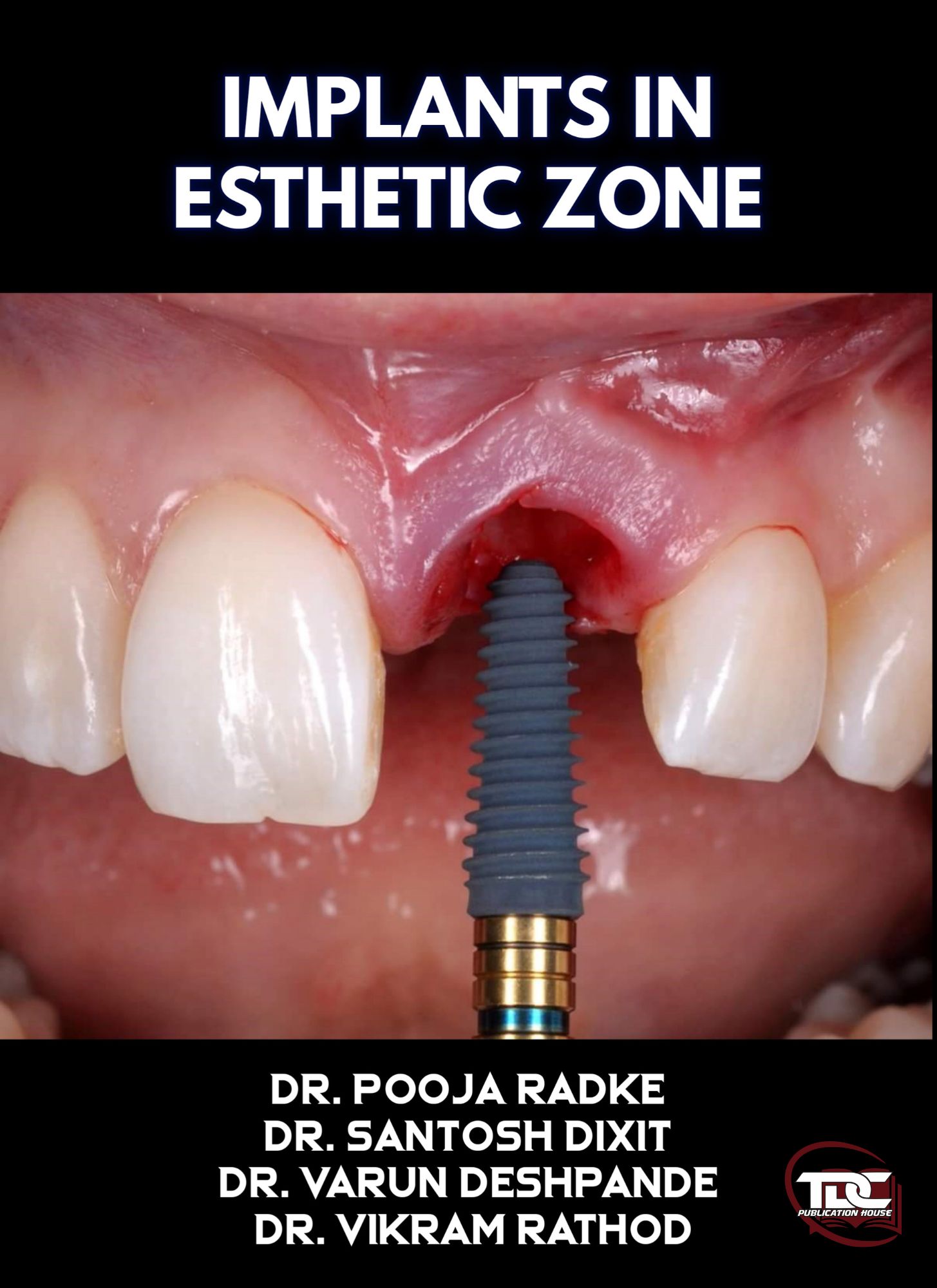 IMPLANTS IN ESTHETIC ZONE